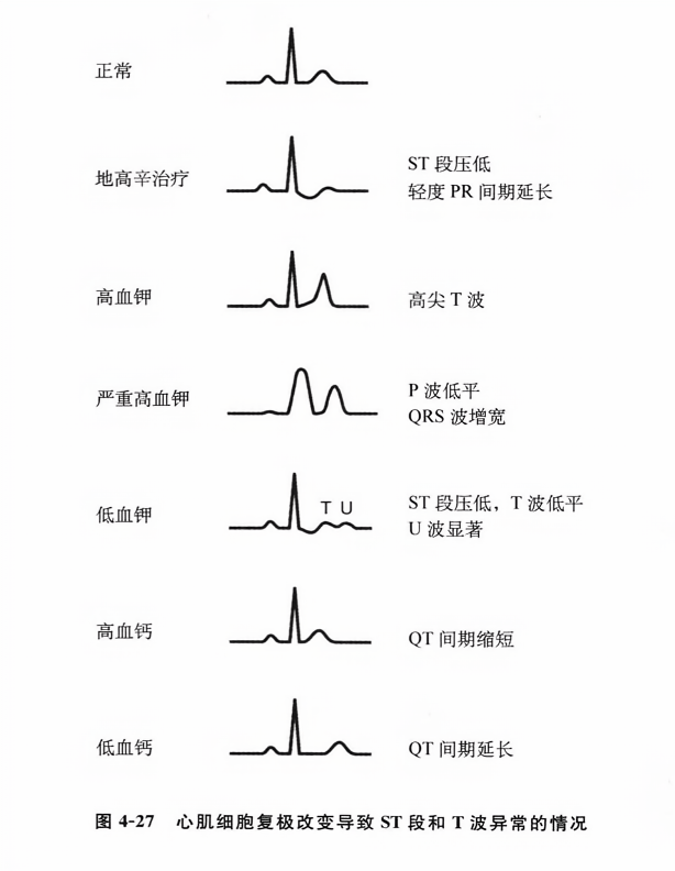 心肌细胞复极改变导致st段和t波异常的情况