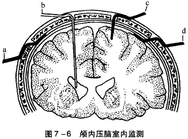 图7-6 颅内压脑室内监测