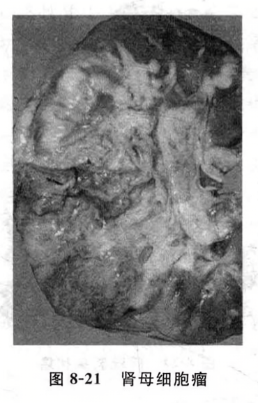肾母细胞瘤