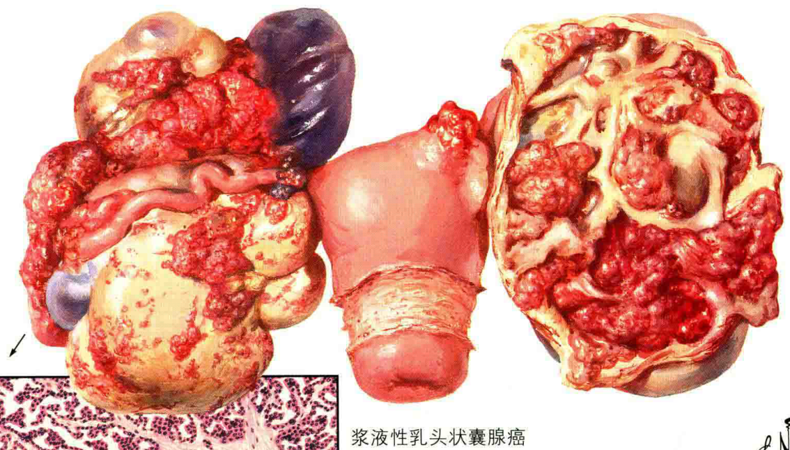浆液性乳头状囊腺癌
