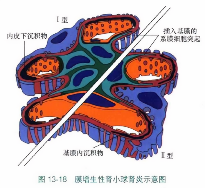 膜增生性肾小球肾炎示意图