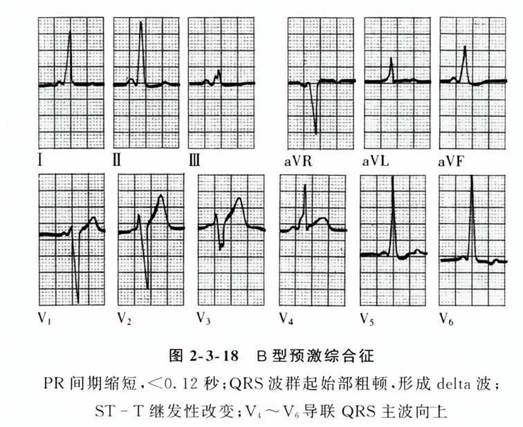 b型预激综合征