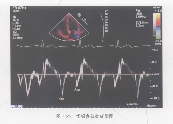 组织多普勒成像图