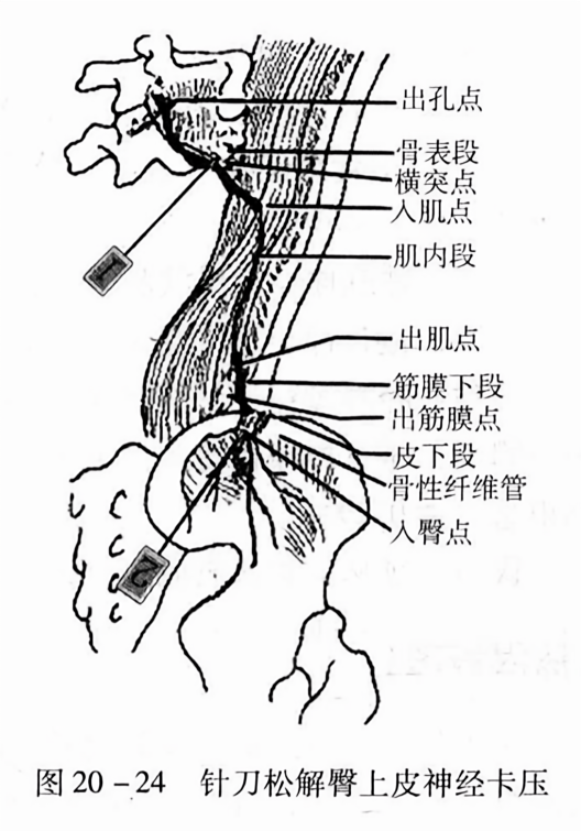 针刀松解上皮神经卡压