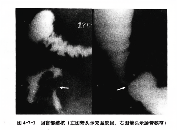回盲部结核(左图箭头示充盈缺损,右图箭头示肠管狭窄)