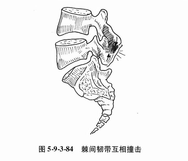 棘间韧带互相撞击