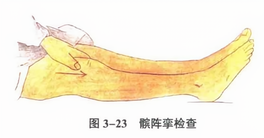 髌阵挛检查
