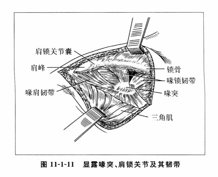 显露喙突、肩锁关节及其韧带