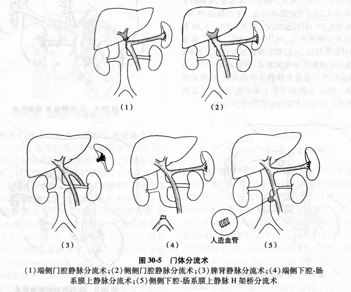 门体分流术