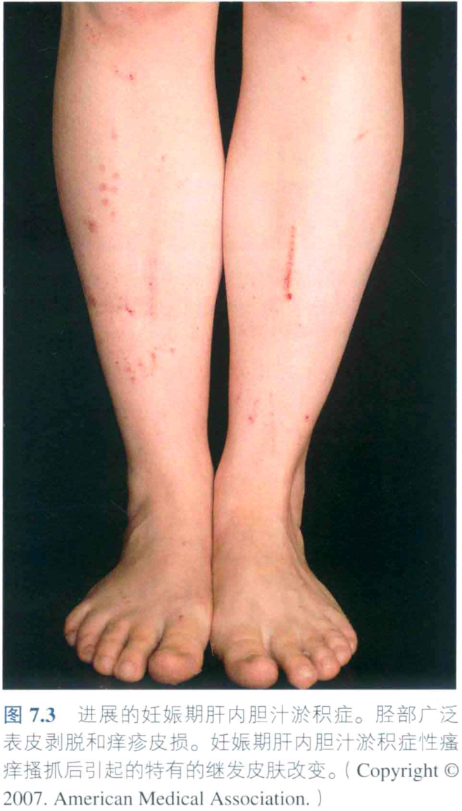 图7.3 进展的妊娠期肝内胆汁淤积症。胫部广泛表皮剥脱和痒疹皮损。妊娠期肝内胆汁淤积症性瘙痒搔抓后引