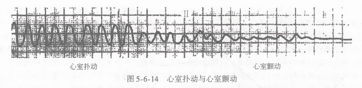 心室扑动与心室颤动