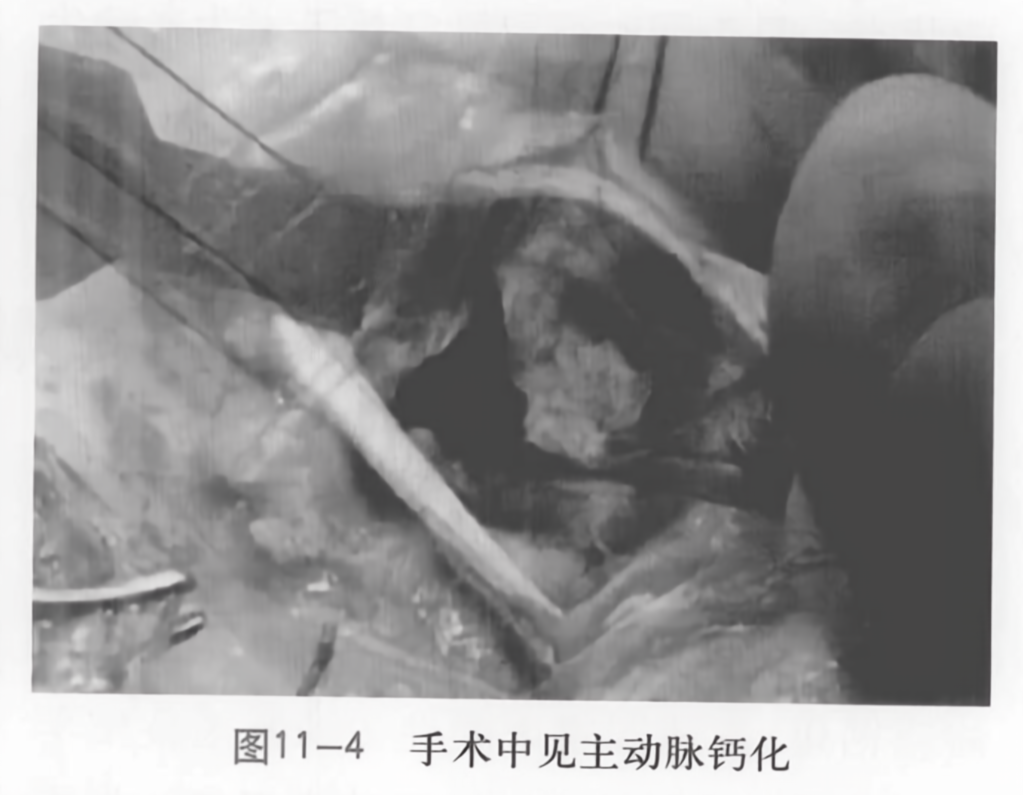 手术中见主动脉钙化