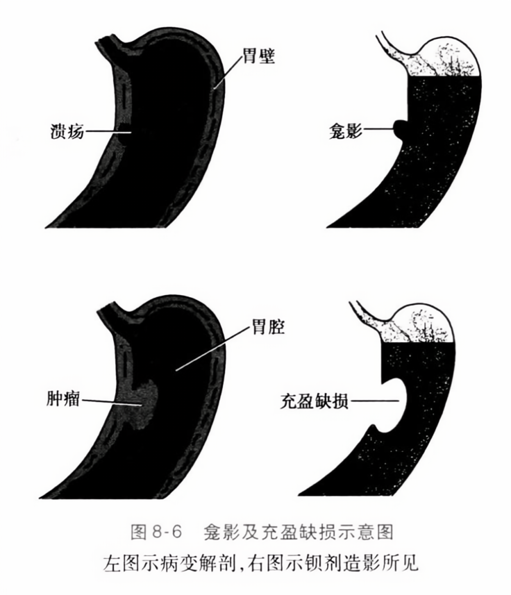 龛影及充盈缺损示意图