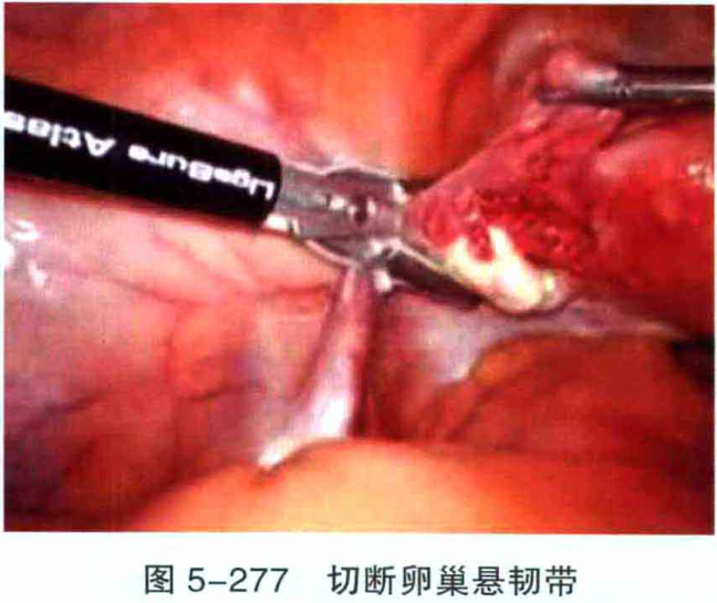 图5-277 切断卵巢悬韧带