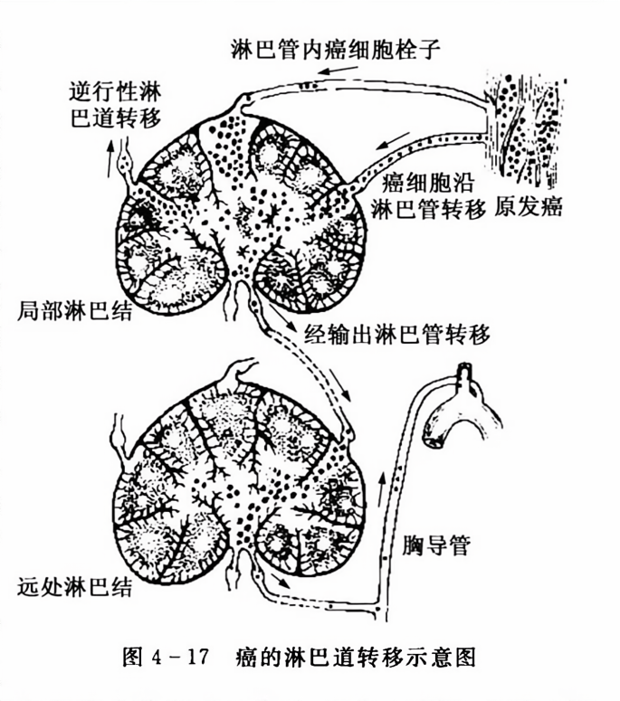癌的淋巴道转移示意图