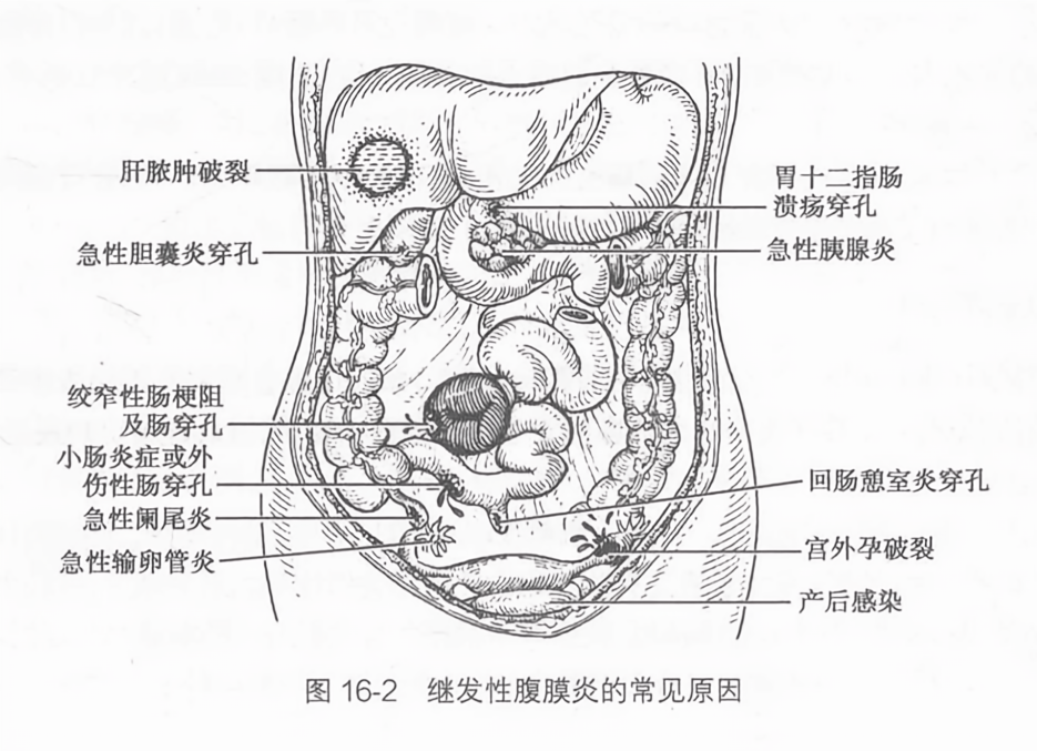 继发性腹膜炎的常见原因