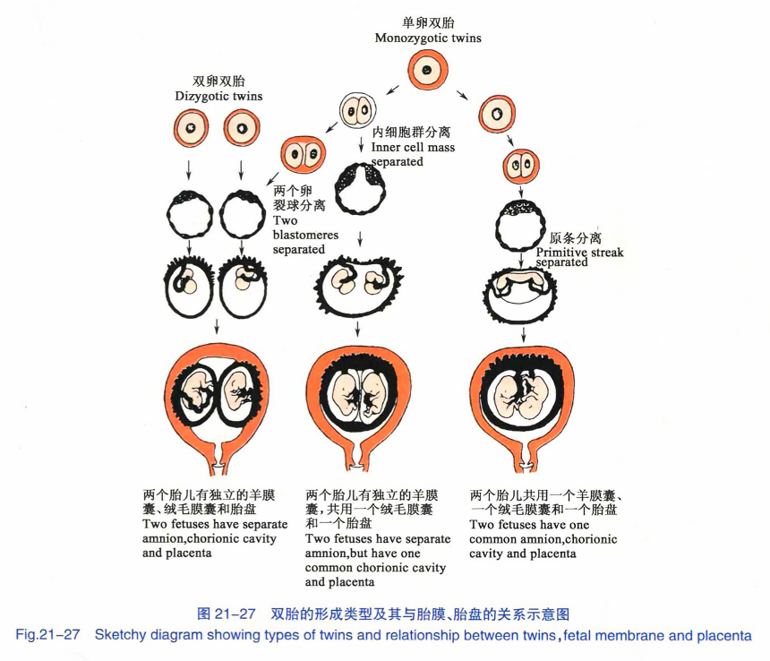 双胎的形成类型及其与胎膜、胎盘的关系示意图