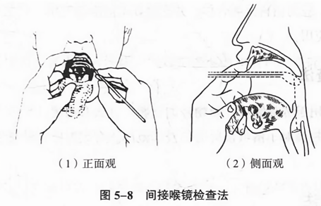 间接喉镜检查法