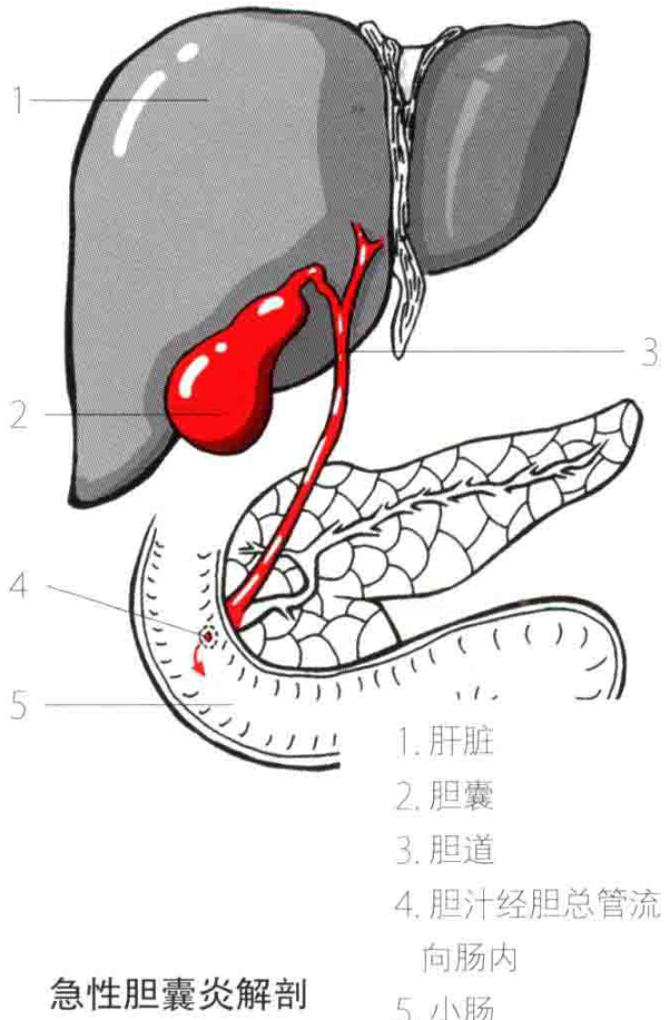 急性胆囊炎解剖