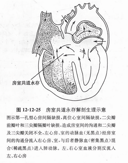 房室共道永存解剖生理示意