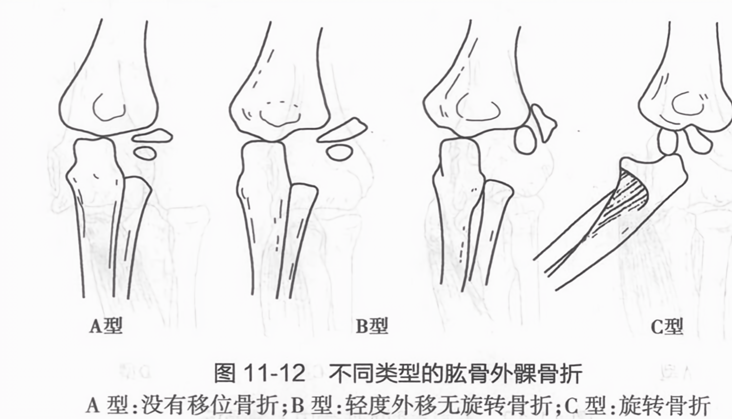 不同类型的肱骨外髁骨折