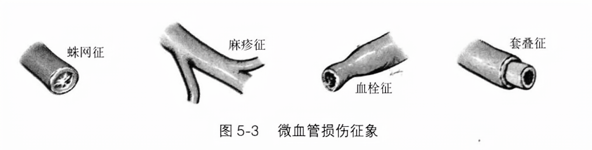 微血管损伤征象
