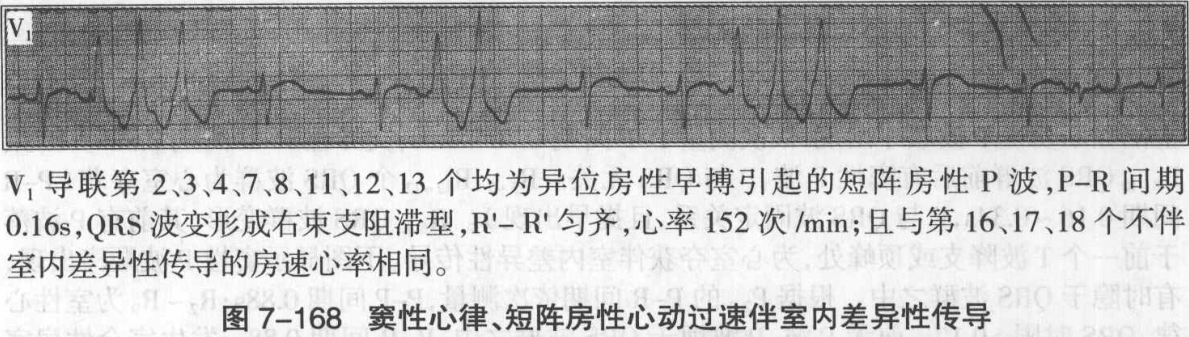 图7-168 窦性心律、短阵房性心动过速伴室内差异性传导