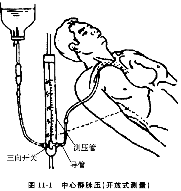 图11-1 中心静脉压(开放式测量)