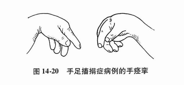 手足搐搦症病例的手痉挛