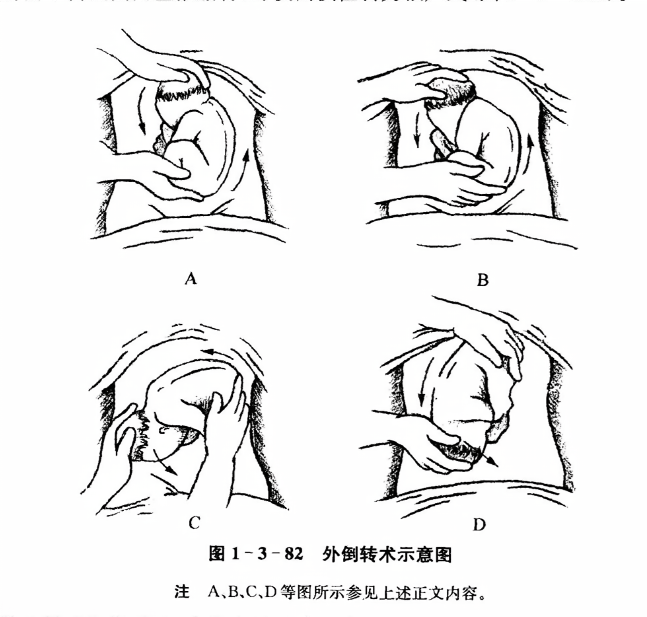 外倒转术示意图