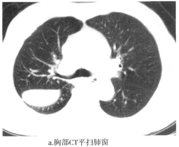 a.胸部ct平扫肺窗