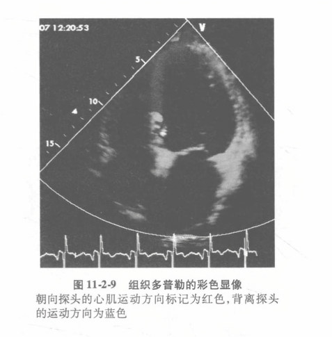 组织多普勒的彩色显像