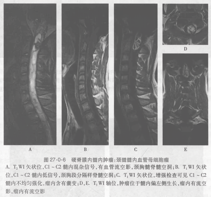硬脊膜内髓内肿瘤,颈髓髓内血管母细胞