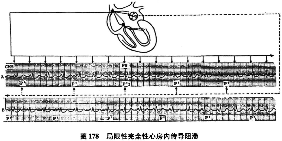图178 局限性完全性心房内传导阻滞