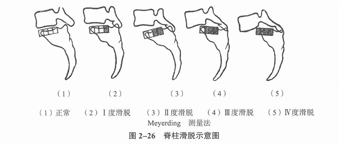 脊柱滑脱示意图