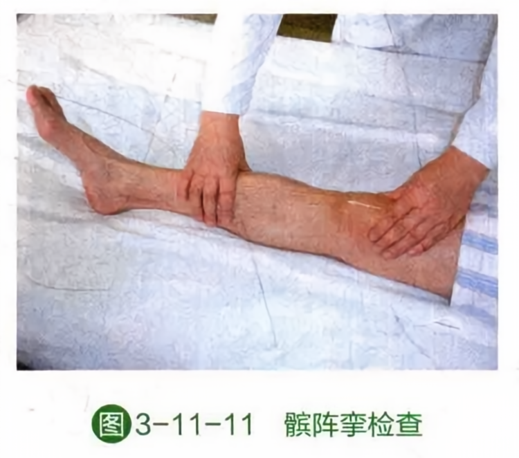 髌阵挛检查