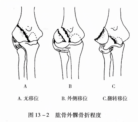 肱骨外髁骨折程度