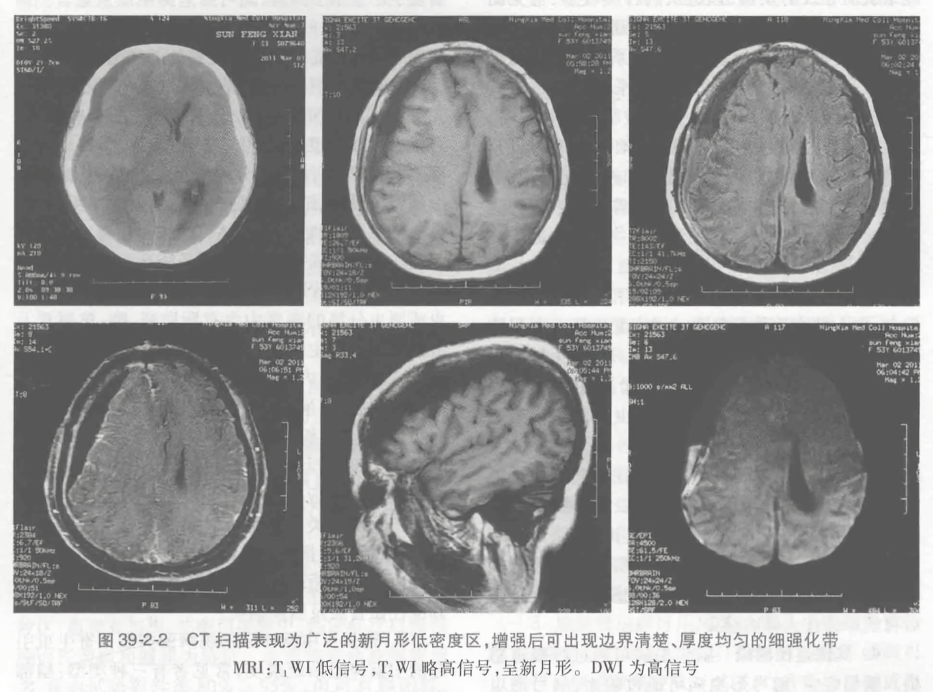 ct扫描表现为广泛的新月形低密度区,增强后可出现边界清楚、厚度均匀的细强化带