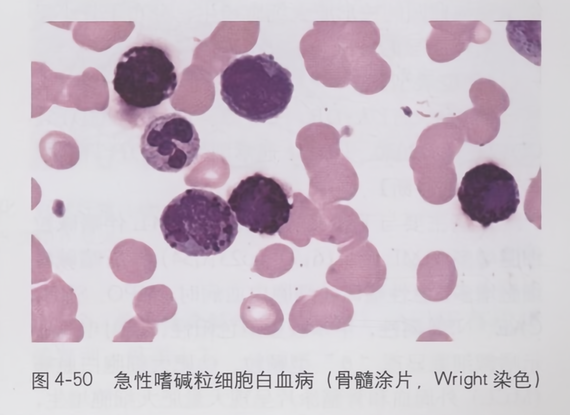 急性嗜碱粒细胞白血病(骨髓涂片，wright染色)