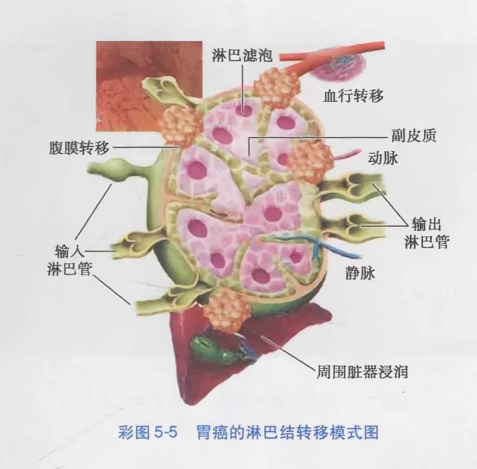 胃癌的淋巴结转移模式图