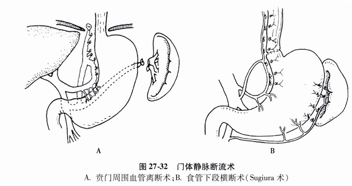 门体静脉断流术
