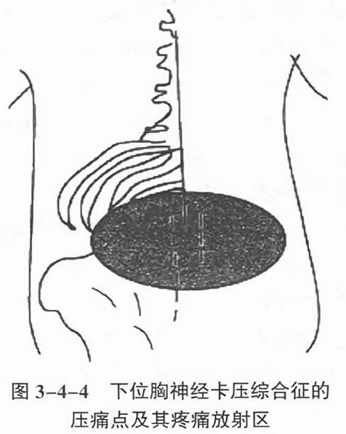 下位胸神经卡压综合征的压痛点及其疼痛放射区