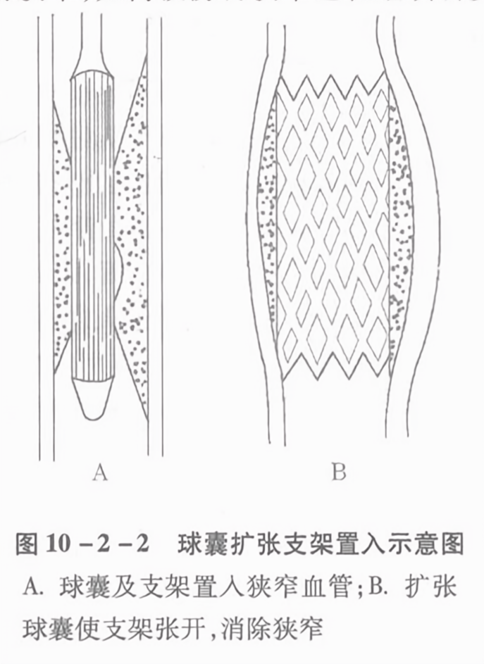 球囊扩张支架置入示意图