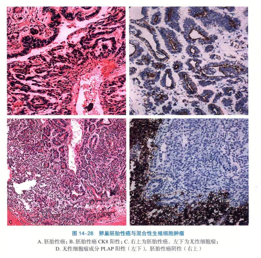 卵巢胚胎性癌与混合性生殖细胞肿瘤