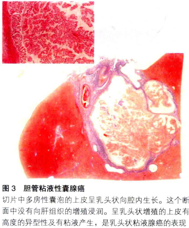 图3 胆管粘液性囊腺癌