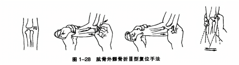 肱骨外髁骨折Ⅲ型复位手法