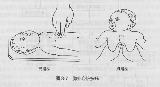 胸外心脏按压