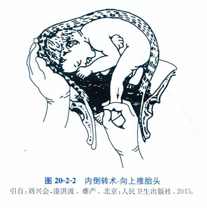内倒转术-向上推胎头