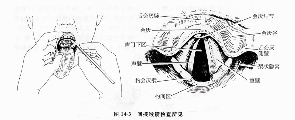 间接喉镜检查所见