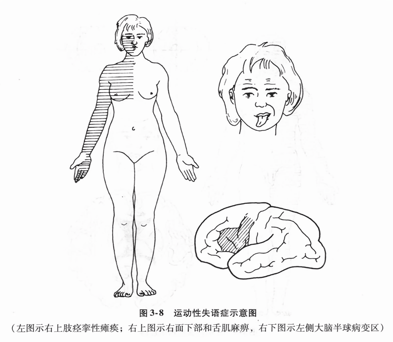 运动性失语症示意图